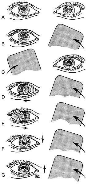 馬篤氏鏡原理|Motor Signs in Heterophoria and Heterotropia